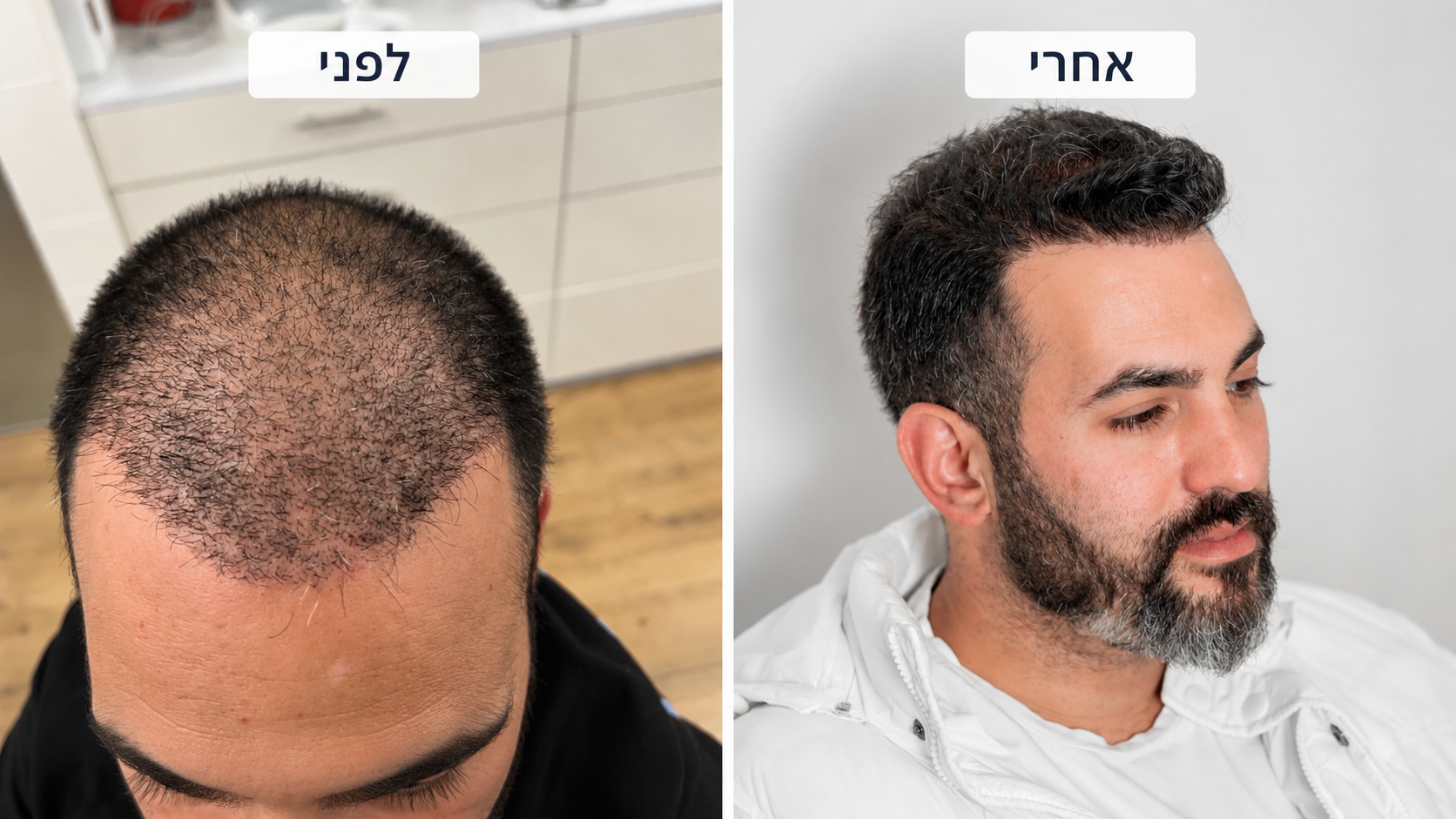 תוצאת השתלת שיער - לפני ואחרי