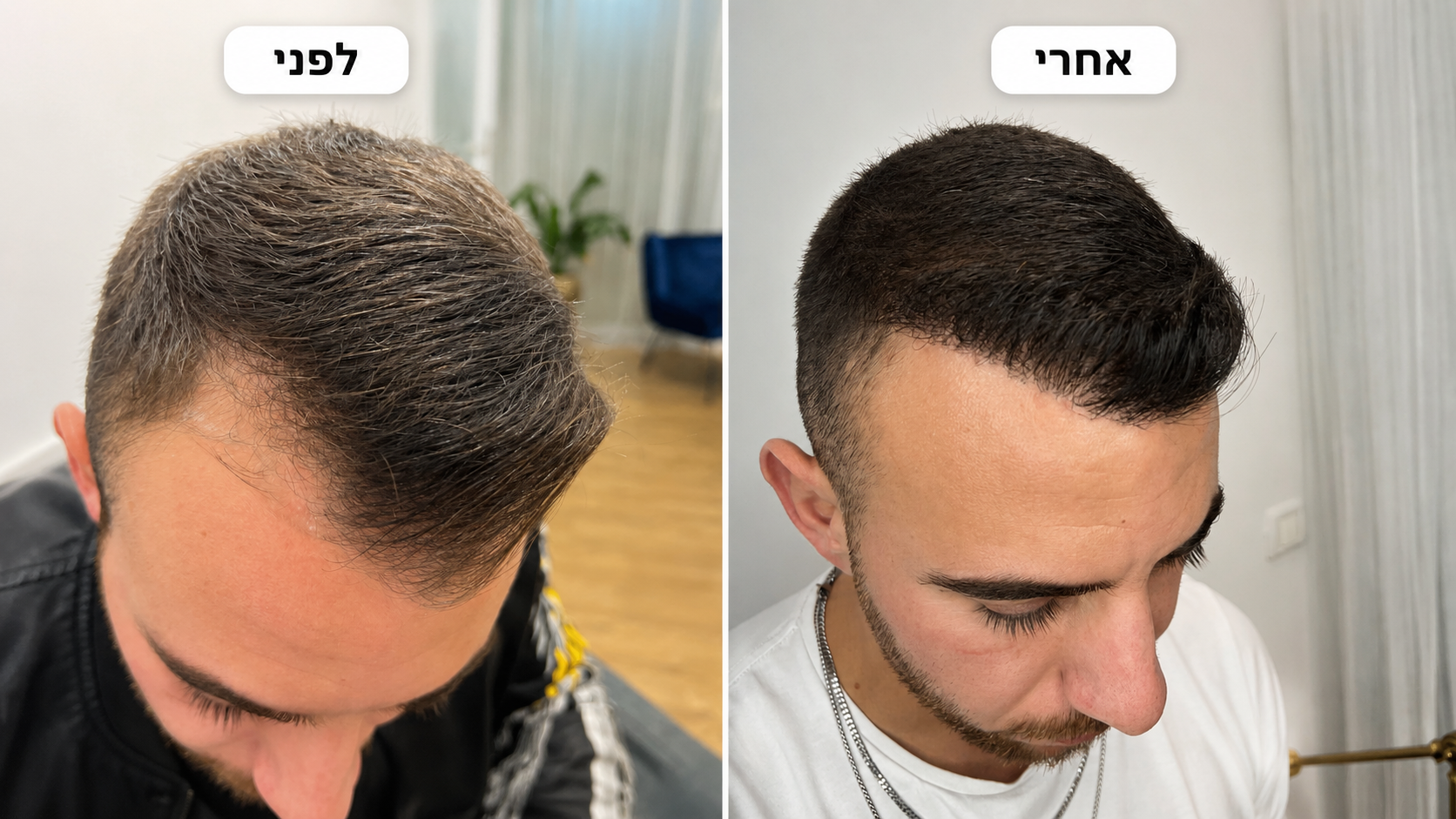 תוצאת השתלת שיער - לפני ואחרי